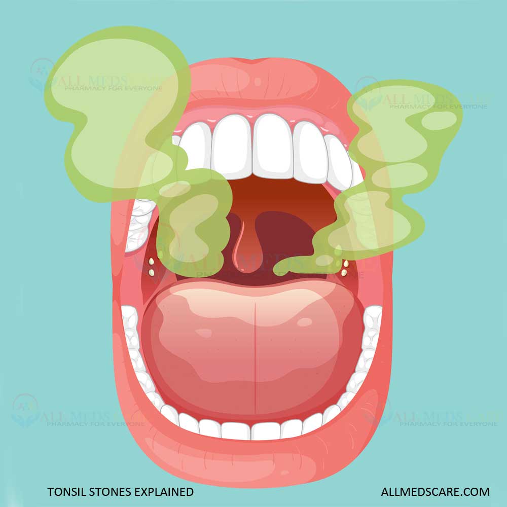 Tonsil Stones Explained: Causes, Symptoms, Effective Remedies